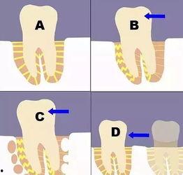 成人牙齿松动视频大全,揭秘成人牙齿松动原因及预防方法