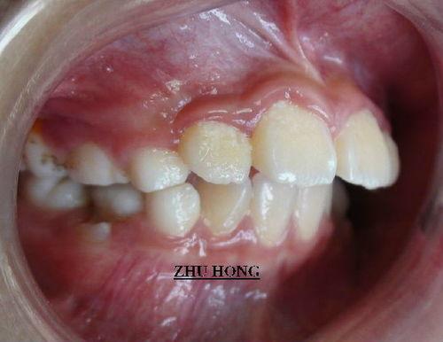 成人替换门牙视频